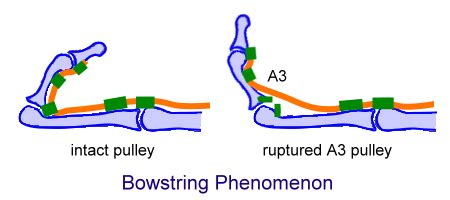 Flexor Tendon Pulley System of Hand