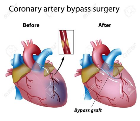 triple bypass surgery - Want Sincere