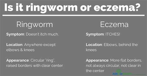 Ringworm | Ask Dr Sears