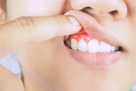 Recognizing The 5 Early Signs Of Gum Disease