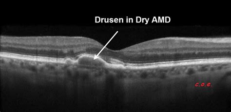 DEGENERACION MACULAR : OCT con curcumina y ALZHEIMER