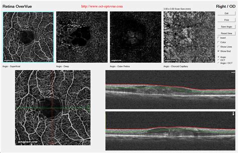 OCT angiography & macular telangiectasia