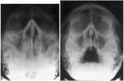 Superior Orbital Fissure Radiology