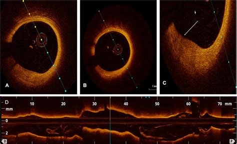 A,B. Follow up OCT after 2 weeks showed complete resolution of red... | Download Scientific Diagram