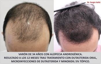 Dutasteride and Minoxidil Before and After Photos | Hair Loss Cure 2020