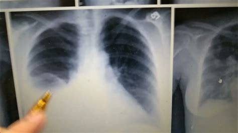 Pulmonology- Radiology- Pleural Effusion Chest X-ray- Loss Of Costophrenic Angle - YouTube