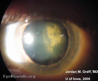 Atlas Entry - Posterior subcapsular cataract