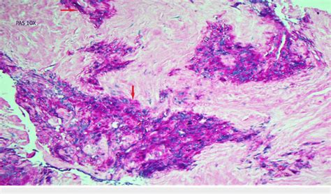 Histopathology slide showing PAS stain positive cells PAS-periodic... | Download Scientific Diagram