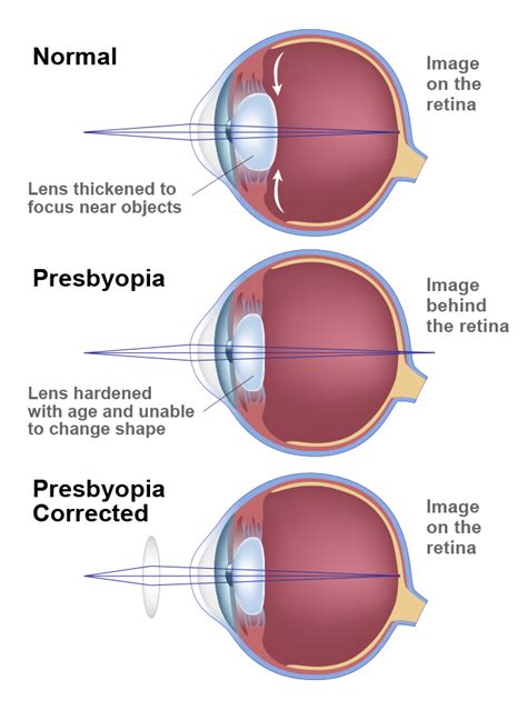 Presbyopia – Toronto, ON - TLC Laser Eye Centers