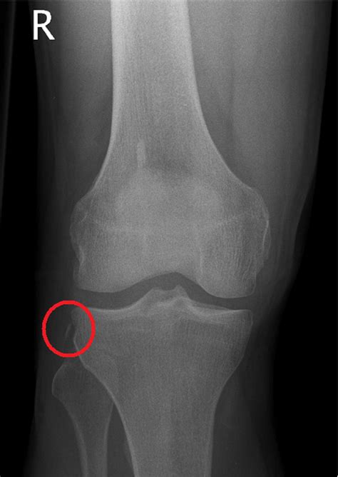 Segond Fracture - Journal of the American College of Surgeons