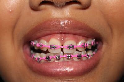 braces colors | Braces UPDATE! Braces Teeth Colors, Pink Braces, Cute Braces Colors, Teeth ...