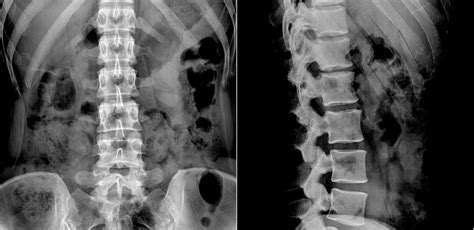 What Are The Different Types of Spinal Implants - Dr. Stefano Sinicropi ...