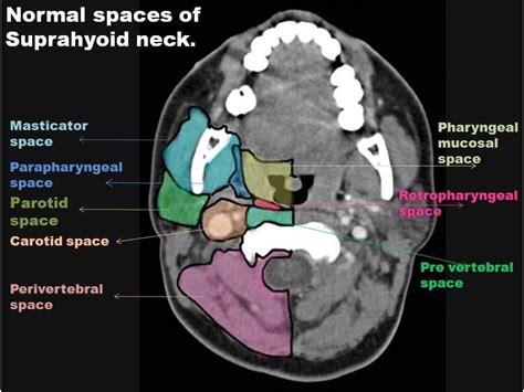 Pin by Mourad Salama on Head And Neck | Medical radiography, Medical anatomy, Radiology