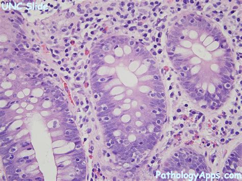 lymphocytic colitis pathology