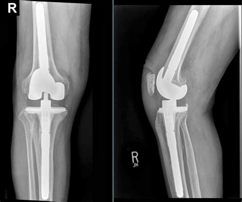 Interesting Topics in Orthopedic Surgery by Dr. Nasar: Severely Bowed ...