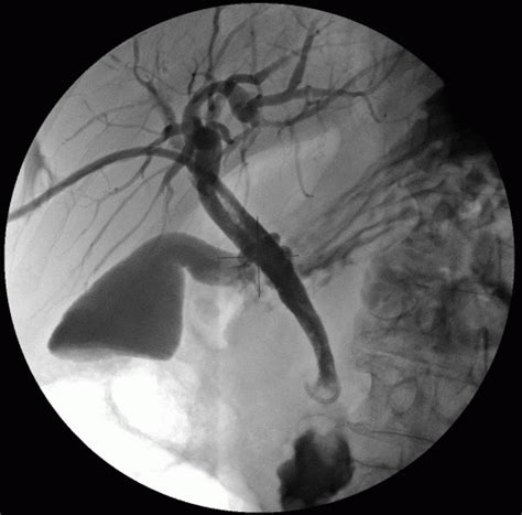 Cholangiography - Wikipedia