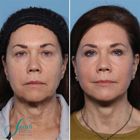 Best Facelift in Columbus, OH | Smith Facial Plastics