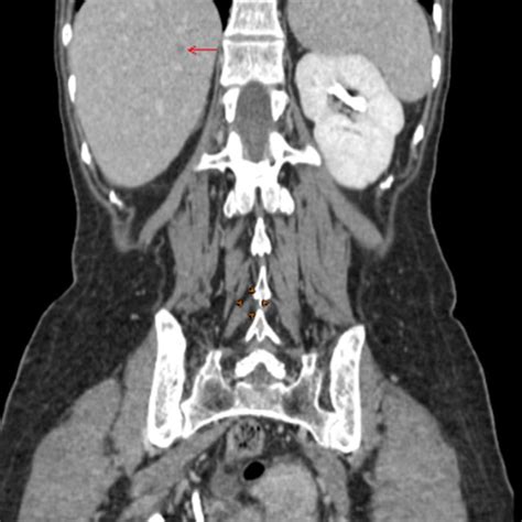 Hypodense lesion in segment VIII of the liver suggestive of metastasis... | Download Scientific ...