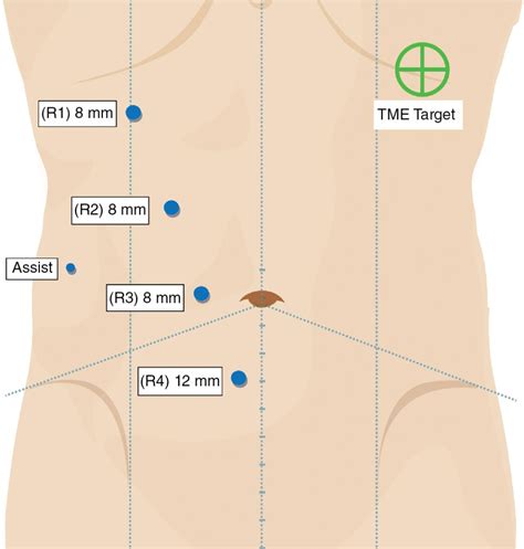 Splenic flexure mobilization | Basicmedical Key