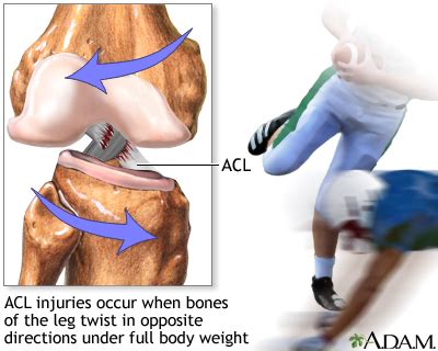 Anterior cruciate ligament (ACL) injury Information | Mount Sinai - New ...