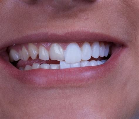 Wonderful Veneers In Auckland | Transform your Smile