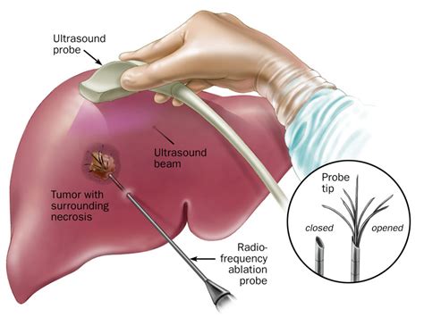 Liver Tumors & Liver Cancer – South Florida Sugical Oncology