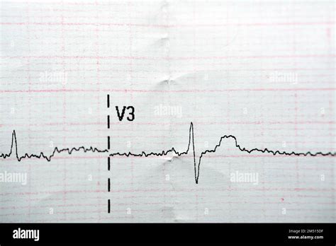 ECG ElectroCardioGraph paper that shows Normal Sinus Rhythm NSR with ...