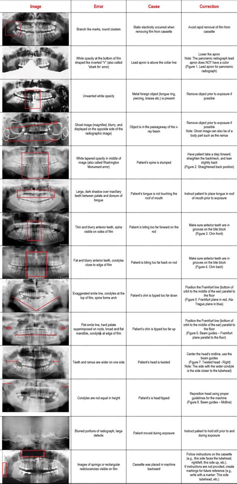 SmarterDA - Dental Assisting Boards Prep Solution Panoramic Radiograph Errors + How to correct them