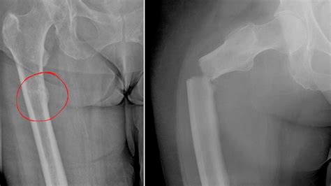 Osteosarcoma X Ray