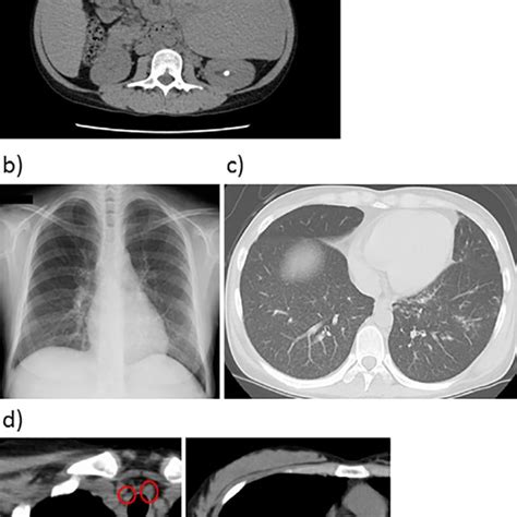 Figure2.Gallium and PET-CT scans. a) Gallium scan and b) -d) PET-CT... | Download Scientific Diagram