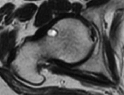 synovial herniation pit | pacs