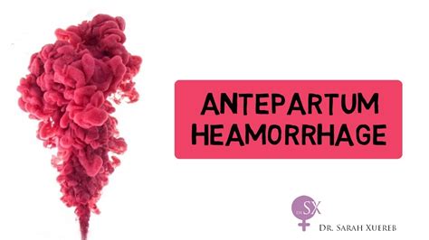 Antepartum Haemorrhage - YouTube