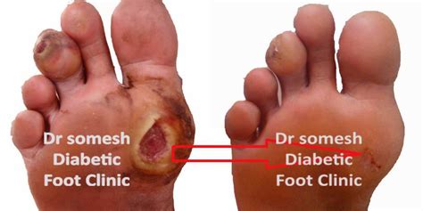 Diabetes Foot Gangrene stages 1st Metatarsal head region - Podiatry Doctor