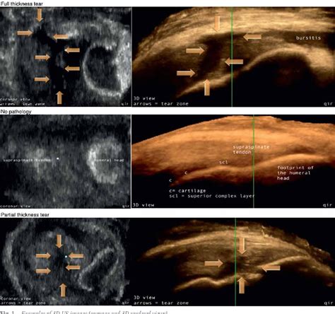 Figure 1 from Inter-rater reliability in the classification of supraspinatus tendon tears using ...