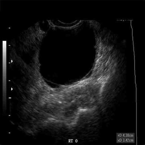 Follicle Detection and Ovarian Classification in Digital Ultrasound Images of Ovaries | IntechOpen