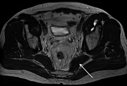 Piriformis Muscle Mri