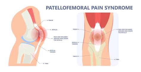 Anterior knee pain surgery - Knee, Hip and Shoulder