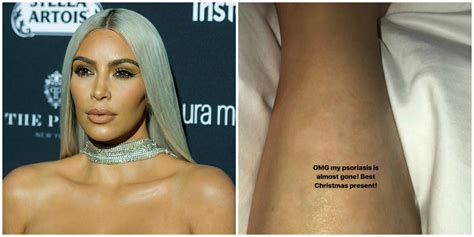 Kim Kardashian Says She Treats Her Psoriasis With Seaweed | Allure