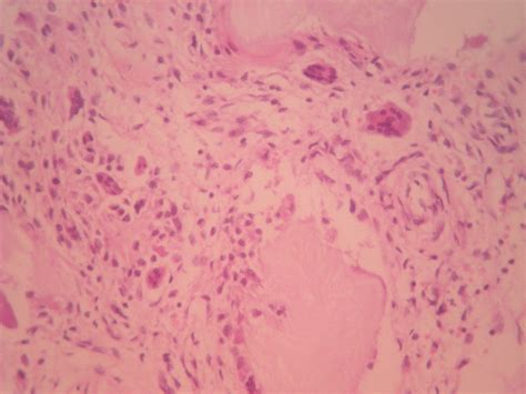 Pathology Outlines - Gout and gouty arthritis