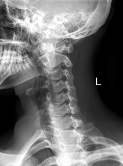 Healthy Cervical Spine Xray