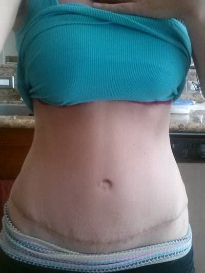 Tummy tuck before after pictures Mexico cosmetic surgeons images » Tummy Tuck: Prices, Photos ...