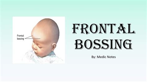 Causes of frontal bossing, mechanism in acromegaly - YouTube