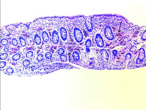 Rectosigmoid biopsy histology showing melanosis coli representing ...