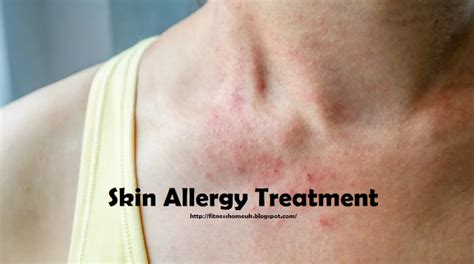 How To Treat Skin Allergy – Skin Allergy Treatment