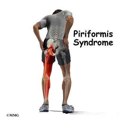 My Traces: MANAJEMEN FISIOTERAPI SINDROM PIRIFORMIS