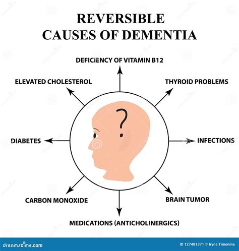 Reversible Causes of Senile Dementia. Alzheimer`s Disease. Infographics Stock Vector ...