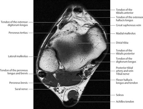 Foot Muscles Mri : Ankle Mri Anatomy Youtube : .magnetic resonance imaging (mri) or ultrasound ...