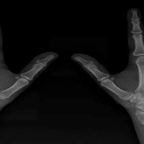 -Hand X-Ray shows periarticular osteopenia. | Download Scientific Diagram