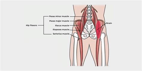 Hip Flexor Strain - The Complete Injury Guide - Vive Health