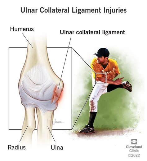 UCL Tear: Baseball player finds relief after a year of elbow pain ...